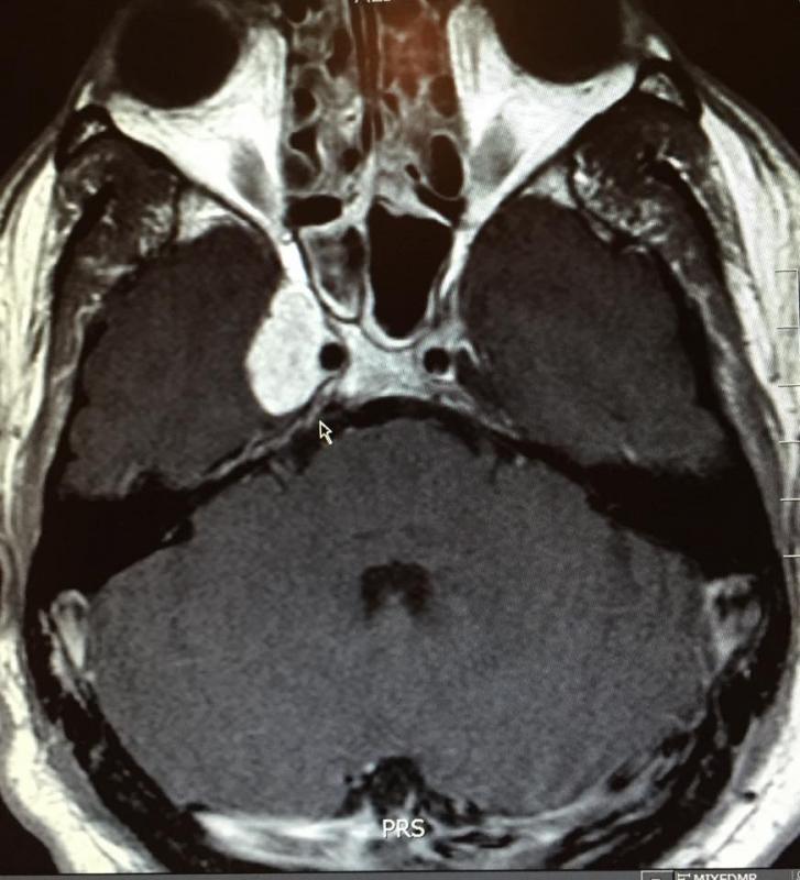 An image of the tumor in Billy Smith’s brain, diagnosed two years ago. Treatments have thus far kept the tumor from growing or spreading. (Courtesy William ‘Billy’ Smith/Facebook)