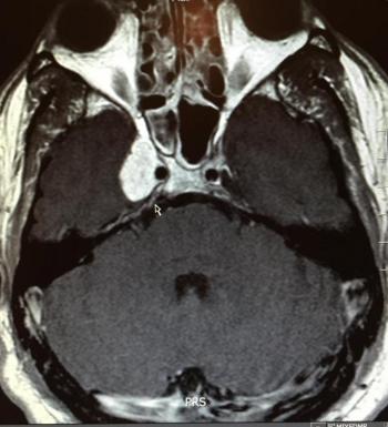 An image of the tumor in Billy Smith’s brain, diagnosed two years ago. Treatments have thus far kept the tumor from growing or spreading. (Courtesy William ‘Billy’ Smith/Facebook)