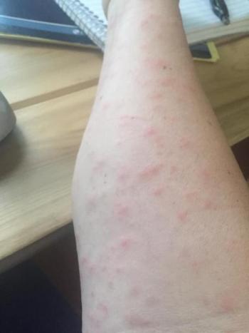 A PenBay Pilot reader shares a photo of her brown tail moth rash symptoms.