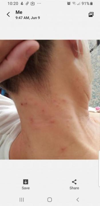 A photo of a neck rash submitted by one of our readers.